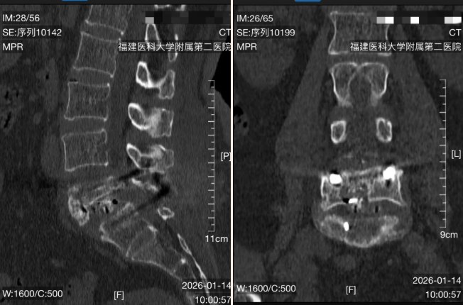 从轮椅回归行走 福医二院脊柱外科三天改写结局